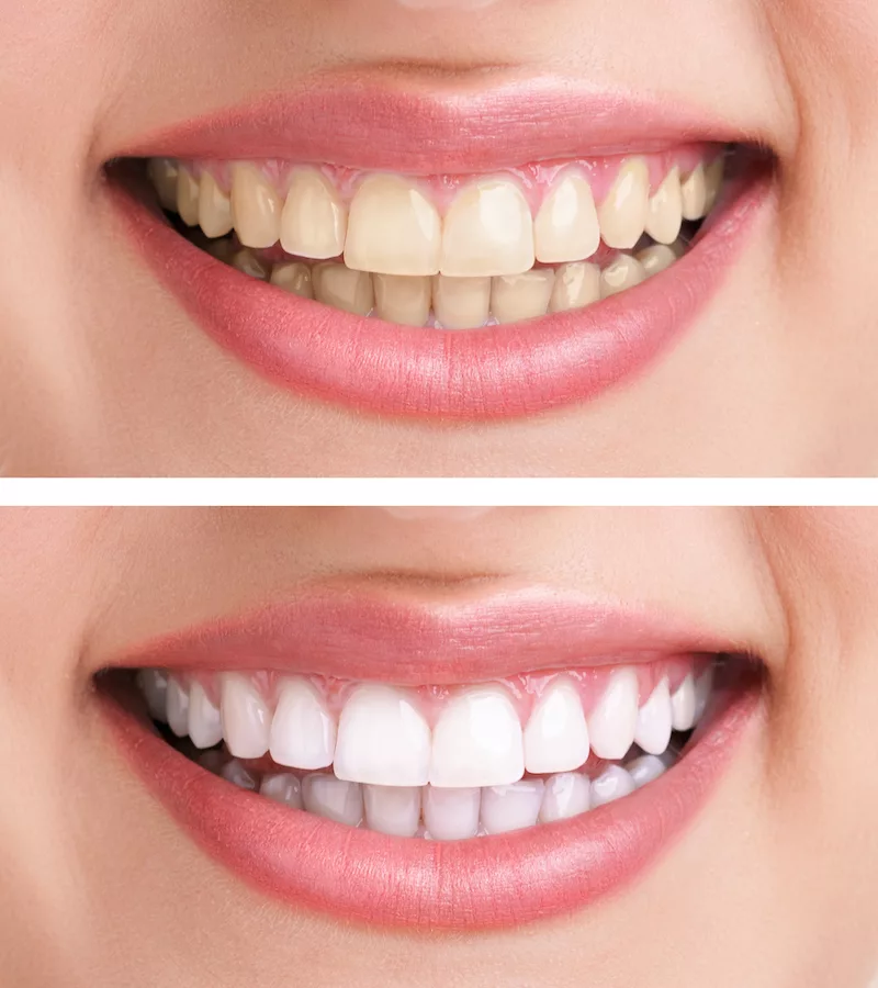 Best Sacramento Teeth Whitening 2024 Sacramento Top 10