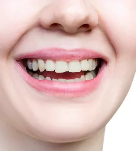 chipped tooth